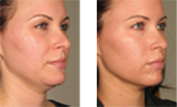 ultherapy