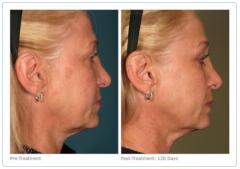 Ultherapy