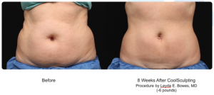 CoolSculpting, no surgery, no downtime treatment in Leesburg, VA at AVIE! Medspa